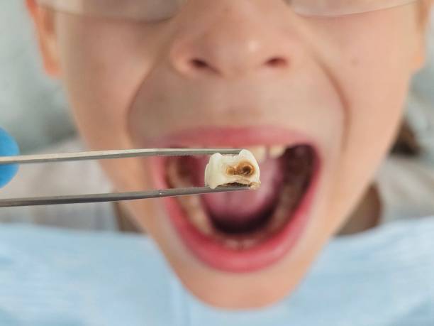 Best Broken or Cracked Tooth Emergency Dentist in Morro Bay, CA